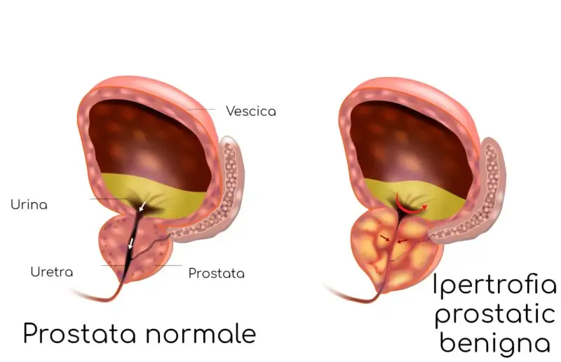 Confronto tra prostata normale e prostata infiammata, dove l'ipertrofia prostatica benigna comprime l'uretra, ostacolando il flusso urinario.
